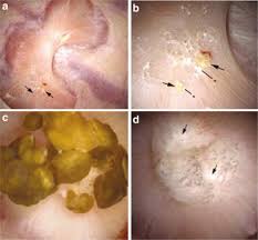 Image result for Calcium Nephrolithiasis