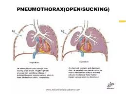 The condition can arise if the chest wall is injured, opened, or if any tear or rupture happens in the pulmonary tissue. What Happens When Someone Is Shot In The Lung How Would It Need To Be Treated Quora