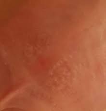 Ausschlag Auf Der Vorhaut Haut Penis