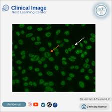 Image result for ANA Staining Pattern