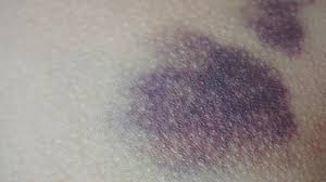 Melt a bar of chocolate in the microwave and rub it on your bruise. 5 Ways To Reduce Bruising