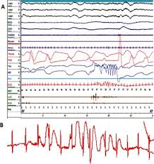 Image result for Polysomnogram