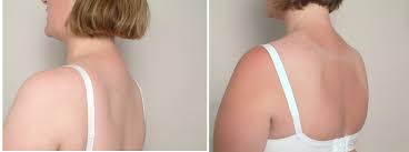 Dowager's hump is an outward curvature of the thoracic vertebrae of the upper back. Buffalo Hump Correction Breast Augmentation Nipple Correction Surgery San Francisco Ca Dr James Romano