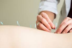 Acupuncture (insertion of needles for remedial purposes). Akupunktur So Wirken Helfen Die Nadeln