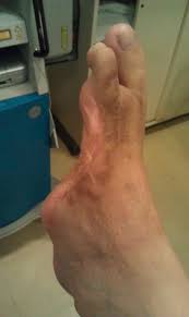 Image result for toe amputation