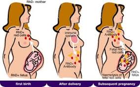 Image result for Rh Sensitization