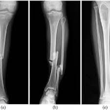 Learn more about the pelvis in this article. Scanning X Ray Image Of Lower Leg Bone Download Scientific Diagram