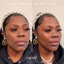 ✨ 7 ML Dermal Filler + Tox Transformation ✨ My gorgeous client came in with  a few specific concerns: • Smooth her smile lines • Get rid of her chin  dimple •