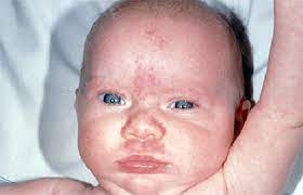 Enlarged lymph nodes in children are much more likely to be a sign of infection than cancer, but they should be checked by a doctor. Birthmarks Signs And Symptoms