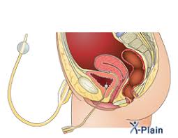 Foley Catheter Female