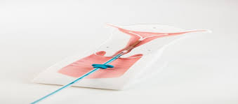 An iud removal normally takes just a few minutes. Crucial Facts You Should Know About Iud Removal