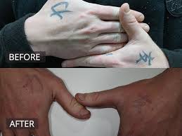 Furthermore, lasers may not remove all the colors, which. Laser Tattoo Removal Melbourne The Doc Clinic Hoppers Crossing
