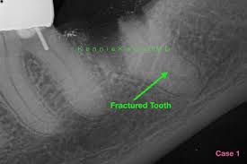 We did not find results for: What To Expect From Bone Grafting For Dental Implants