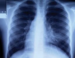 This article explains what affects your rib cage, back muscles, and ligaments that support the spine in some cases, pain on the left side under ribs towards the back could actually be from organs that pain that is related to your heart may start off as squeezing pressure or tightness in your chest before. Rib Bone Britannica