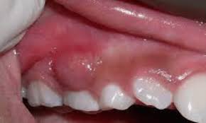 Image result for Periodontal Abscess