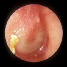 Image result for Acute Otitis Externa