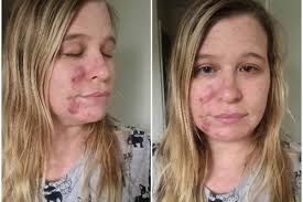 Woman hails £85 skincare kit as 'miracle cure' for her cystic acne