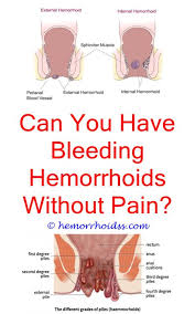 How To Get Rid Of Hemorrhoids Home Remedies Bleeding Hemorrhoids Hemorrhoids Getting Rid Of Hemorrhoids
