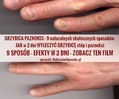 Grzybica Paznokci Jak W 2 Dni Wyleczyc Grzybice Stop I Paznokci I