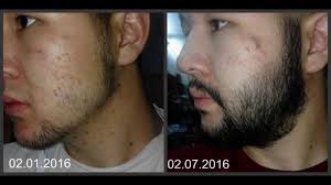 Before i hop into the technical side of minoxidil and using it on your beard, here were a few people that saw great results by beard and minoxidil application: Minoxidil Beard Growth Real Before And After Photos