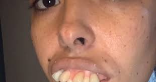 Lindsay lohan shocked fans when she debuted a new look in 2011. Woman S Teeth Transformation Gets Millions Of Views But Some Spot A Problem Mirror Online