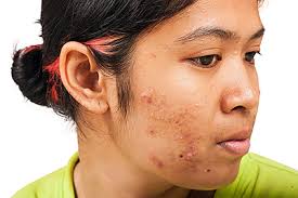 The best time to start using active treatments on dark marks is when the marks are no longer an open injury. How Long Can I Take An Antibiotic To Treat My Acne