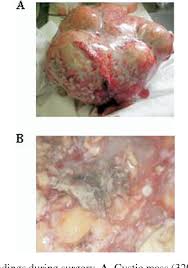 We did not find results for: Figure 2 From Giant Mature Ovarian Cystic Teratoma Including More Than 300 Teeth Semantic Scholar