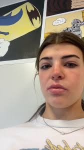 Swollen Eyelids Mono