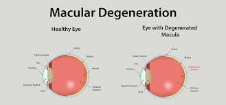 Degenerescenta maculara reprezinta deteriorarea maculei, fiind o boala oftalmologica in urma careia apare distrugerea vederii centrale. 20 Remedii Eficiente Pentru A Vindeca Degenerarea Maculei Ro Hair Action Com
