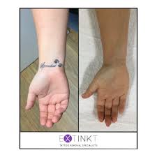 We did not find results for: Before After Tattoo Removal Results Laser Tattoo Removal Specialists