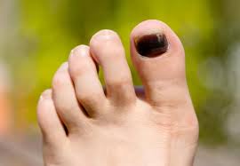 Image result for toe black diabetes