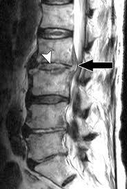 Image result for Spinal Infection