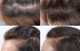 Visit insider's health reference library for more advice. Nutrafol For Hair Loss Does Nutrafol Work Women S Health