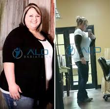Pin On Before And After Gastric Sleeve Surgery Pictures