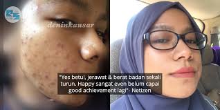 Semua orang nak kulit berseri dan licin gebu. Pakai Skincare Apa Pun Tak Akan Jadi Badan Penuh Toksin Punca Kulit Breakout Erin Sakura