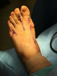 Post Operative Bunion And Hammertoe Surgery Hammer Toe Surgery Bunion Surgery Bunion