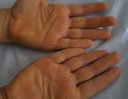 There could be a few different reasons for red spots on the palm of the hand including pregnancy, psoriasis, and arthritis. Yellow Discoloration And Hyperkeratosis Of The Palms In An 8 Year Old Boy Download Scientific Diagram