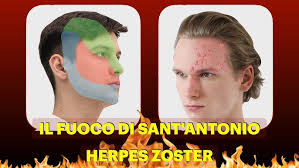 Fuoco di Sant'Antonio, una dolorosa eruzione cutanea