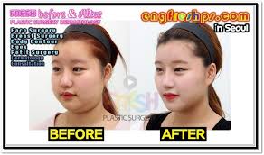 Korea Plastic Surgery Engfreshps Com Korea Plastic Surgery Splendid Korea Plastic Surgery G Korean Plastic Surgery Plastic Surgery Plastic Surgery Korea