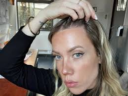 Woman who had hair transplant to cover 'big forehead' reveals results