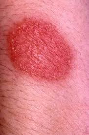 Lorsque la barrière physique que constitue la peau est lésée ou fragilisée,. Mycose De La Peau La Mycose Ou Champignon De La Peau Teleconsultation Dermatologue