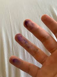 Ninhydrin Will React With A) Amino Acids And Proteins B) Carbohydrates C)  Aldehydes D) Carboxylic Acids To Give A Deep Purple Violet Color. 2)  Fingerprints Can Be Stained With A) Ninhydrin B)