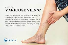 This can happen because of pregnancy, constipation, a tumor, or overweight and obesity. Varicose Veins What S The Deal And How To Heal The Derm Dermatologists In Cook County Il