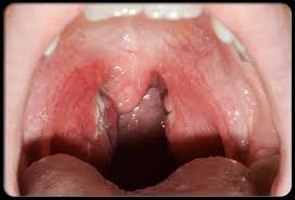 Was Ist Herpes Osophagitis Herpes Im Hals