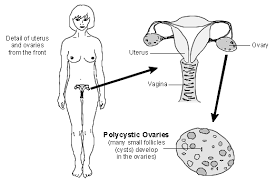 microsoft word polycystic ovary syndrome