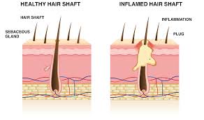 Image result for folliculitis symptoms