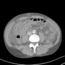 Image result for Neutropenic Colitis