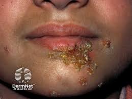 Image result for Impetigo