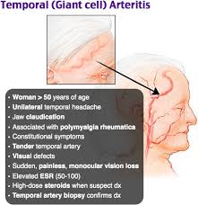 Image result for Jaw Claudication