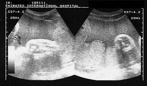 We did not find results for: A Gallery Of High Resolution Ultrasound Color Doppler 3d Images Amniotic Fluid